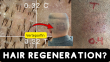 How Can Verteporfin Cure Hair Loss?