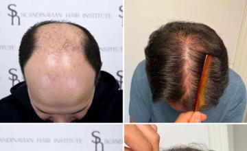 Dr Emil George - NW 6 - First surgery 19/01/2024 4400 graft second surgery 19/02/2025 3600 graft - Total 8000 graft