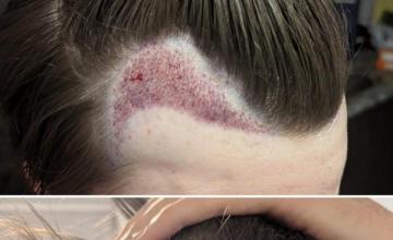 Dr Konior FUE - 1200 grafts