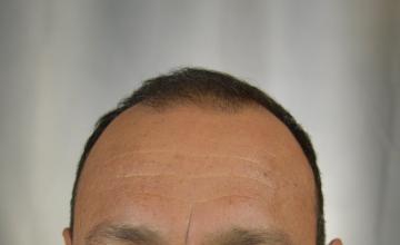 Dr. Arocha | 2500 graft FUE on an AGA NW 4/5
