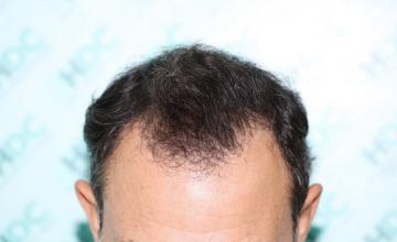 Hairline Natural Result with 2720 FUE grafts – HDC Hair Clinic