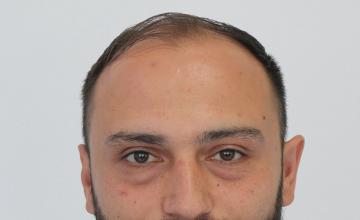 Dr Resul Yaman Hair Clinic - 4860 Grafts Result