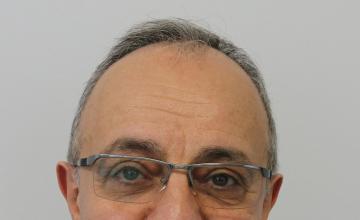 Dr Resul Yaman Hair Clinic - 3415 Grafts Result