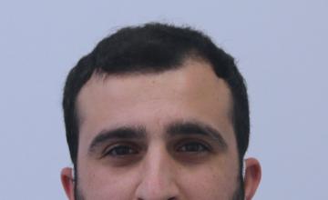 Crown loss reconstruction - favourable hair characteristics (Dr Arshad, The Hair Dr Clinic, LEEDS UK)