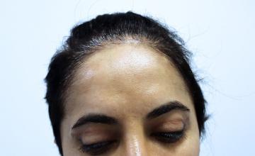 Dr Resul Yaman Hair Clinic - 2780 Grafts Female Hair Transplant Result