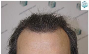 DR. Rafael de Freitas - 3302 GRAFTS / 7603 Hairs - FUE