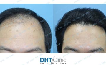 Dr. Damkerng Pathomvanich (DHT Clinic) / Combination of FUT and FUE (3,731 grafts), 2 years and 2 months post op