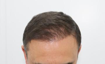 Dr Resul Yaman Hair Clinic - 2860 Grafts