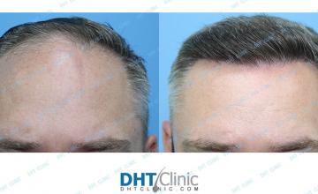 Dr. Damkerng Pathomvanich (DHT Clinic) / FUE 3,380 grafts / post-op  10 months