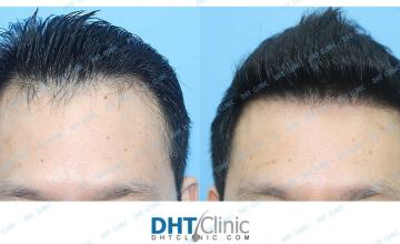 Dr. Damkerng Pathomvanich (DHT Clinic) / Restoration of frontal hairline and crown/ Combo 3137  grafts (2588 FUT and 594 FUE) / post-op 7 months