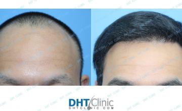 Dr. Damkerng Pathomvanich (DHT Clinic) / Restoration of frontal hairline and temple/ FUE 2,484 grafts / post-op 5 months