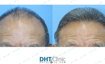 Dr. Damkerng Pathomvanich (DHT Clinic) / Restoration of frontal hairline in 73 years old / Combo 2,955 grafts / post-op 7 months