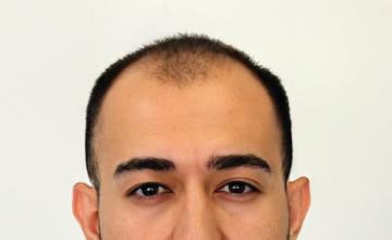 Dr Resul Yaman Hair Clinic - 4520 Grafts Result