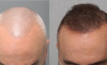 Dr. Kongkiat Laorwong, MD, FISHRS, FUE 4000 grafts, 8 months post op.