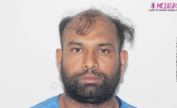 Dr. Suneet Soni - 5498 Grafts, 2 Years Result, Combine FUT + FUE + Beard Technique, NW-VI