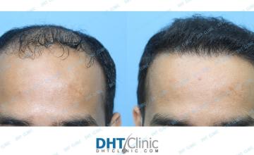 Dr. Damkerng Pathomvanich (DHT Clinic) / Combination FUT and FUE 3659 grafts, 4 months post op