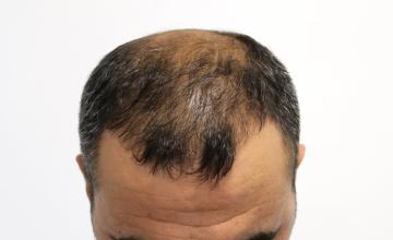 Dr Resul Yaman Hair Clinic - 4320 Grafts