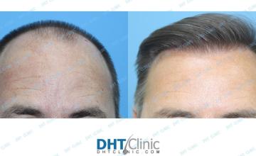 Dr. Damkerng Pathomvanich (DHT Clinic) / FUE 3,009 grafts in Norwood Class V-VI