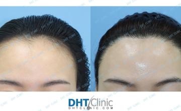 Hair Transplant in women by FUE 2984 Grafts by Dr. Damkerng Pathomvanich