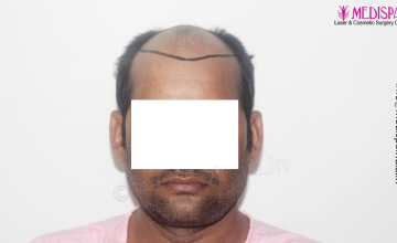 Dr. Suneet Soni - 4992 Grafts | 12-Month Result | Combination FUT + FUE + Beard