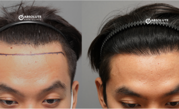 Dr. Kongkiat Laorwong, MD, FISHRS,  strip FUT 2000 grafts, 8 months post op.