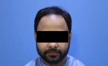Dr. Kapil Dua | 2526 Graft Bio FUE | 12 Month Results