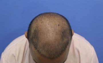 2000 Grafts FUE Hair Transplant Result | AK Clinics