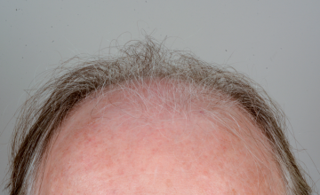 Robert Haber, MD - 2819 grafts FUT, Front - 6 months