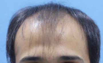 Eugenix India - 15 Months Hair Transplant Update | 2670 Grafts Norwood Grade 4A