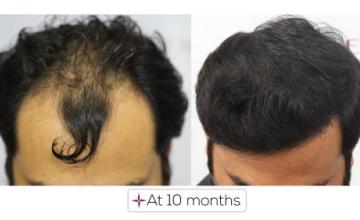 10 months hair transplant update - 2560 Grafts Norwood Grade 4A @Eugenix Hair Sciences