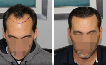 Dr. Bloxham | 2,500 Graft "Slick" Result | 6 Months | Feller & Bloxham, NY