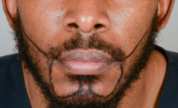 Robert Haber, MD - 964 grafts FUT, Beard - 6 months