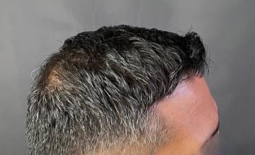 Dr. Arocha | 2000 graft FUE