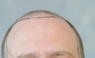 Dr. Arocha | 4056 graft FUT Procedure | 18 month results