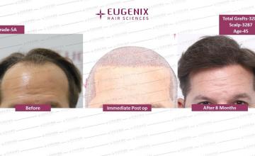 Blonde Caucacian Hair: 5 months update @Eugenix Hair Sciences