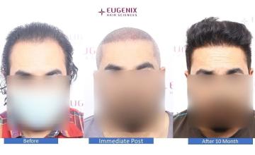 Mastering traction-induced alopecia @Eugenix Hair Sciences | 9 Month Results