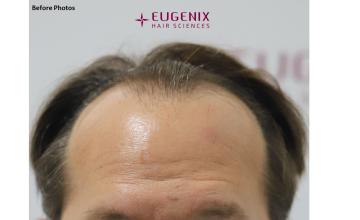 Norwood VA 3,287 Grafts Hairline Restoration @Eugenix Hair Sciences