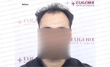 Norwood III 2,844 Grafts Hairline Restoration @Eugenix Hair Sciences