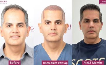 EUGENIX HAIR SCIENCES | NW3 | 6.5 MONTHS RESULT | DR. ARIKA BANSAL