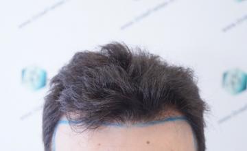 Dr. Rafael de Freitas - 2192 Grafts - 6469 Hairs