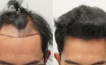 Dr. Kongkiat Laorwong, MD, FISHRS,  FUE 3100 grafts, 7 months post op