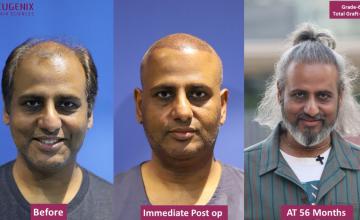 EUGENIX HAIR SCIENCES | NW6 | MAKE BALDNESS A HISTORY