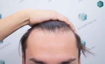 Dr. Rafael de Freitas - 2363 Grafts, 5734 Hairs - FUE