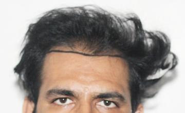 Dr. Suneet Soni - 3600 Grafts, NW-IV, Front & Crown Area Covered