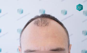 Dr. Rafael de Freitas - 5079 Grafts - Diffuse alopecia