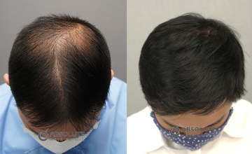 Dr. Kongkiat Laorwong, MD, FISHRS, FUE 3150 grafts, 8 months post op