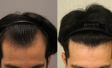 Dr. Kongkiat Laorwong, MD, FISHRS, FUE 3400 grafts, 8 months post op