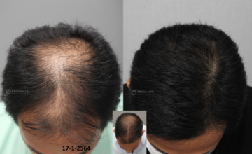 Dr. Kongkiat Laorwong, MD, FISHRS, FUE 3770 grafts, 11 months post op