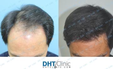 Dr. Damkerng Pathomvanich (DHT Clinic) / FUT 2,527 grafts post-op 8 months
