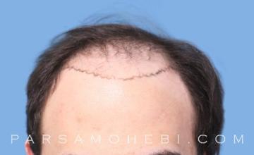 35 Year Old Male with Class VI Hair Loss by Dr. Parsa Mohebi